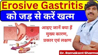 Erosive Gastritis A Comprehensive Guide to Causes Symptoms and Treatmentdrramakantsharma7 [upl. by Talley339]