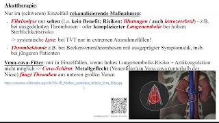 TVT  tiefe Venenthrombosen  Phlebothrombose [upl. by Beberg]