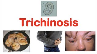 Trichinosis Pork Parasite  Pathophysiology Signs amp Symptoms Diagnosis Treatment [upl. by Eitak569]