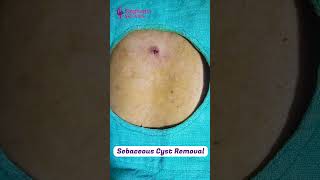 Sebaceous Cyst Removal  Singhania skin clinic Raipur [upl. by Killian800]