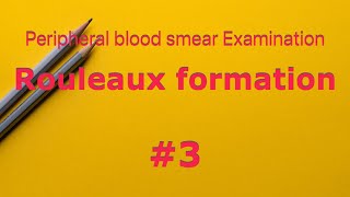 Rouleaux formation  peripheral blood smear Examination  Hematology  Multiple Myeloma ESR [upl. by Farver]