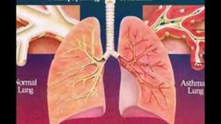 Pathophysiology of asthma [upl. by Aihsemot]