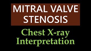 Mitral Valve Stenosis  Chest Xray Interpretation [upl. by Ittocs]