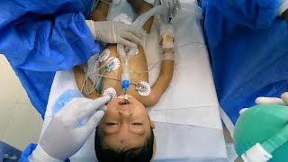 Pediatric Anesthesia Intubation Lessons  Anesthesiologist POV [upl. by Cerys621]