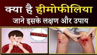 Hemophilia in hindi I हीमोफीलिया क्या होता है I हीमोफीलिया क्या है I हीमोफीलिया [upl. by Heymann]