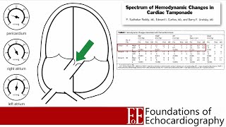 Level 1 Video Lecture Pericardial Effusions and Cardiac Tamponade [upl. by Leonidas]