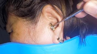 Removing Grandmas 70 Year Old Earwax  Its STUCK [upl. by Gabie]