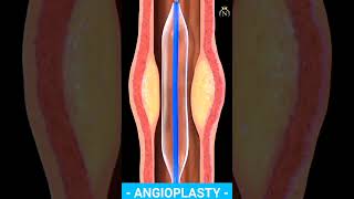 Angioplasty 3D Animation shorts angioplasty medical short viral [upl. by Onitsuaf]