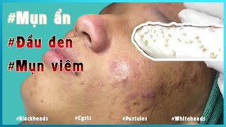 Big Cystic Acne Blackheads Extraction Blackheads amp Milia Whiteheads Removal Pimple Popping [upl. by Acirem615]