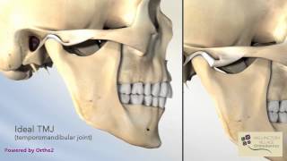 Closed Lock TMJ Lock Jaw  Wellington Village Orthodontics [upl. by Nryhtak712]