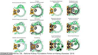 Updates in Glomerular Disease [upl. by Shirline847]