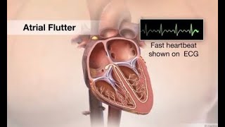 ECG Interpretation Atrial Flutter Explained [upl. by Ciredor]