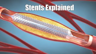 What is a stent 3D animation [upl. by Ellsworth]