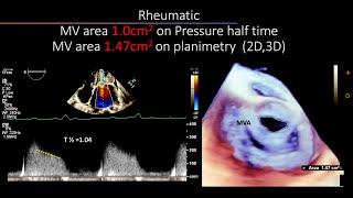 In Mitral Stenosis disparity between various methods to assess MV area [upl. by Michigan780]