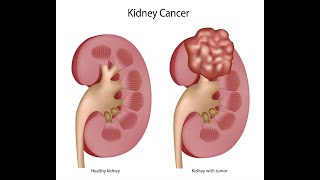 What Is Kidney Cancer [upl. by Brom]