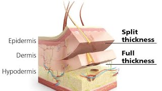 Skin Graft amp Flaps  MSK Module [upl. by Underwood]