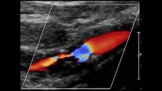 hemodynamic stenosis of the internal carotid artery [upl. by Ecienal]