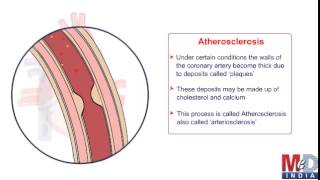 Coronary Artery Bypass Surgery [upl. by Janik]