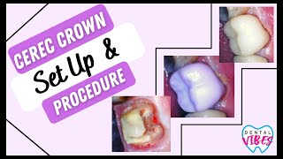 CEREC CROWN PREP SET UP amp PROCEDURE  Dental Assistant Tips [upl. by Paige741]