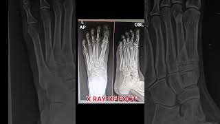 X ray of foot radiology [upl. by Nivrae]