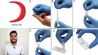 Sickle cell anemia  causessymptoms diagnosis test procedure treatment amp pathology sicklecell [upl. by Eirhtug24]