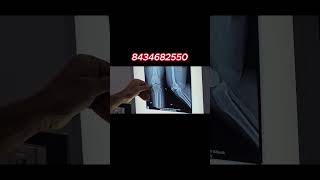 backpaintreatment chiropractic sciatica backpainrelief back backpain pain chiropractor [upl. by Ramilahs519]