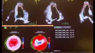 Cardiac Amyloidosis shown on strain [upl. by Epul683]