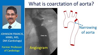 What is coarctation of aorta [upl. by Solana]