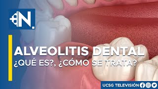 Alveolitis dental ¿Qué es y cómo se trata l Lo mejor del día Viva Mejor TV [upl. by Slosberg]