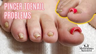 Pedicure Tutorial on Pincer Toenails that Cause Pain [upl. by Adim]