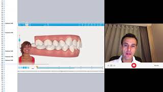 Clincheck review to solve crossbite with Invisalign [upl. by Anstice]