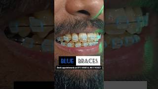 BLUE Braces at Bhatia Dentopulse smile colors braces [upl. by Farny]