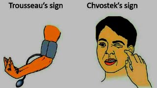 chvostek and trousseau sign  hypocalcemia carpopedal spasm  electrolyte imbalances chvostek sign [upl. by Ortrude]