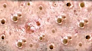 Amazing Blackheads Remover on the Face 003 [upl. by Salene998]