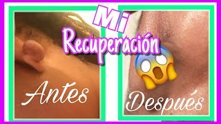 OPERACION DE QUELOIDE MI RECUPERACION [upl. by Jerrilee521]