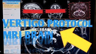 Mri Brain VERTIGO PROTOCOL with anatomy and pathology in simple way⚠️ [upl. by Jolynn]