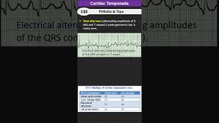 Cardiac Tamponade Pitfalls amp Tips [upl. by Tait]