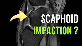 Scaphoid Impaction Syndrome vs Osteoid Osteoma of Scaphoid on MRI [upl. by Adien948]