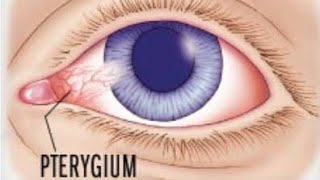 Pterygium  what is pterygium  treatment and surgery options [upl. by Sirovaj]