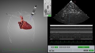 HeartWorks Pneumothorax [upl. by Haraz]