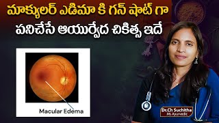 This is the Ayurvedic treatment that works like a gun shot for macular edema  DrSuchitha Challa [upl. by Yrrol]