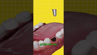 How A Dental Implant Works 😮 [upl. by Redmer]