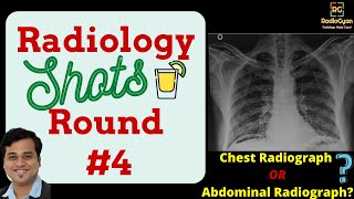 Pneumoperitoneum Why a chest radiograph is preferred over abdominal radiograph All 4 reasons [upl. by Eldnik957]