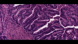 Digital Surgical Pathology 31 Dedifferentiated Endometrial Carcinoma [upl. by Aihseyk763]