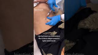 Tighten lose abdominal skin sculptra collagenstimulation skintightening antiaging [upl. by Janey]