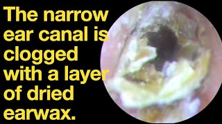 The narrow ear canal is clogged with a layer of dried earwaxear wax removal  ear cleaning  ASMR [upl. by Cuttler]