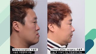 Class 3 Malocclusion Treatment amp Surgery Post OP 11 DAYS [upl. by Micki]