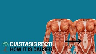 What Causes Diastasis Recti  Diastasis Ed 3 [upl. by Cochard]