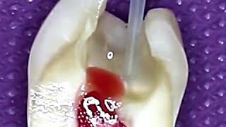 Pulpotomy Procedure This is How Tooth is Cleaned and Prepared for Dental Cavity  Tooth Filling [upl. by Delos941]