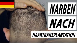 Haartransplantation Türkei Vorher Nachher Spenderbereich 110 MonateDonor Area Results [upl. by Nonnek771]